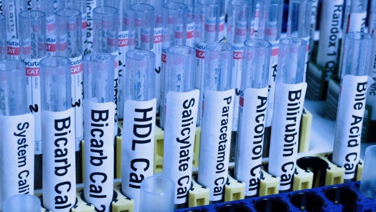 Bluttest-Röhrchen für Autoimmunprotokoll - begleitende Blutuntersuchungen